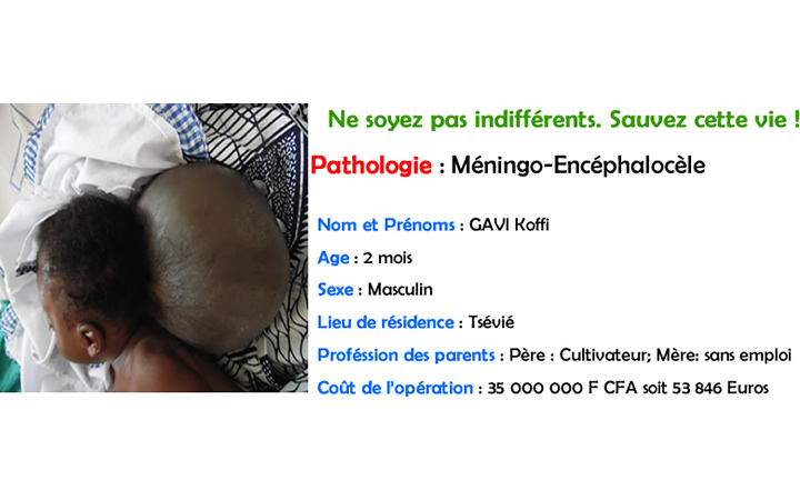 GAVI Koffi (meningo encephalocèle)